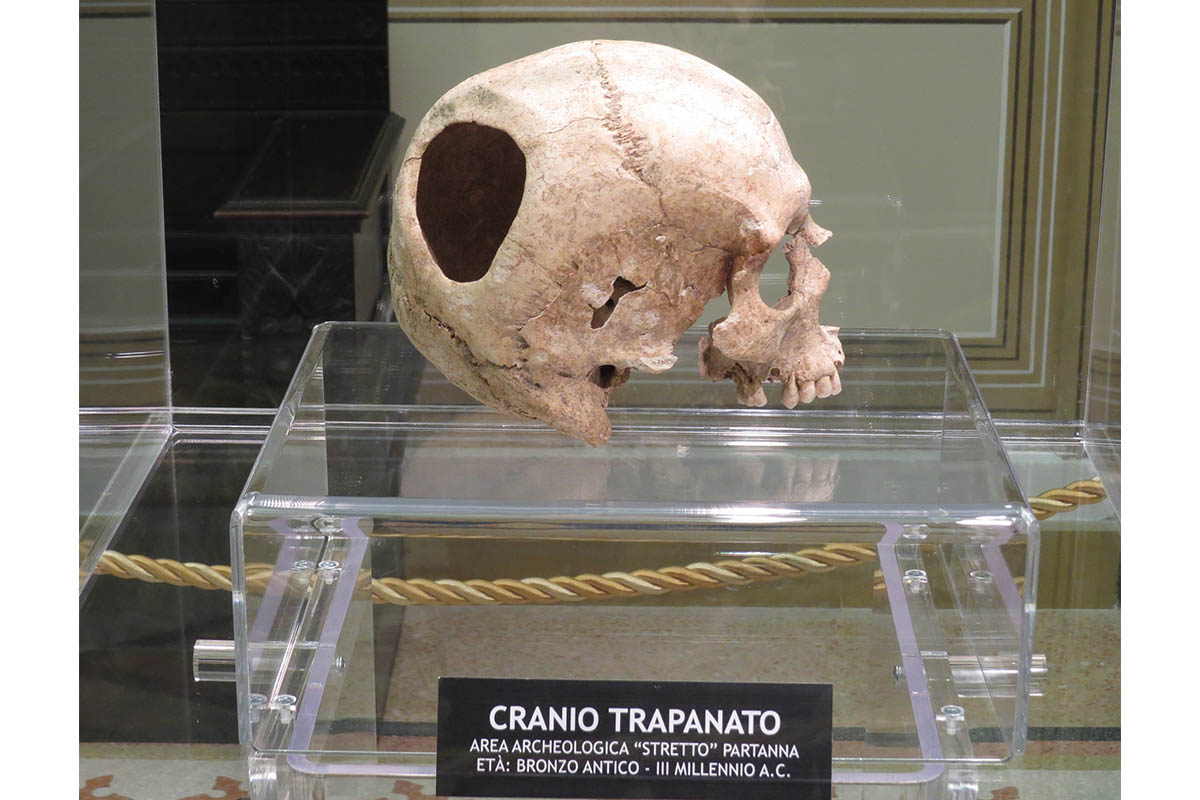 Partanna, Castello Grifeo, Museo Di Preistoria Del Belice – Cranio Trapanato Foto E. Rossi